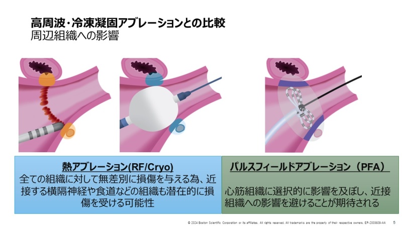 高周波・冷凍凝固アブレーションとの比較